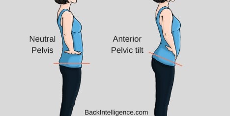 Woman with a natural pelvis and then a pelvis tilt